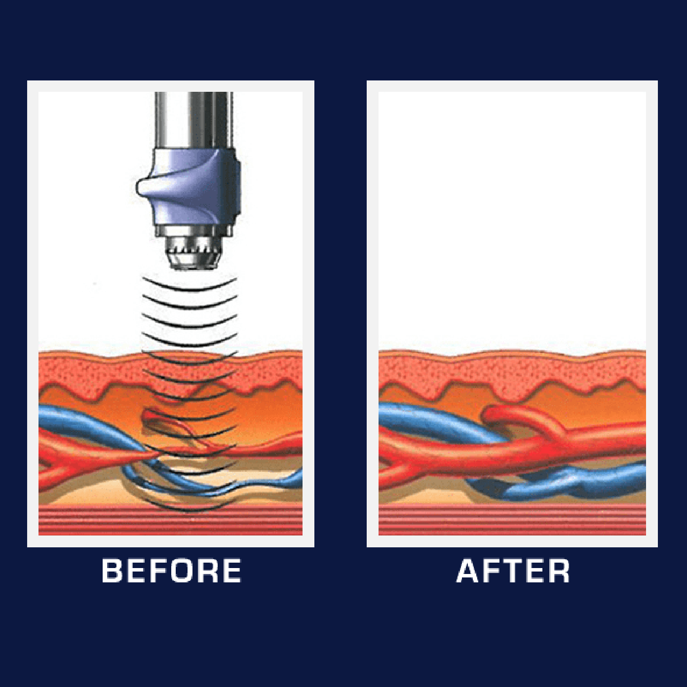 P Shot Penis After And Before